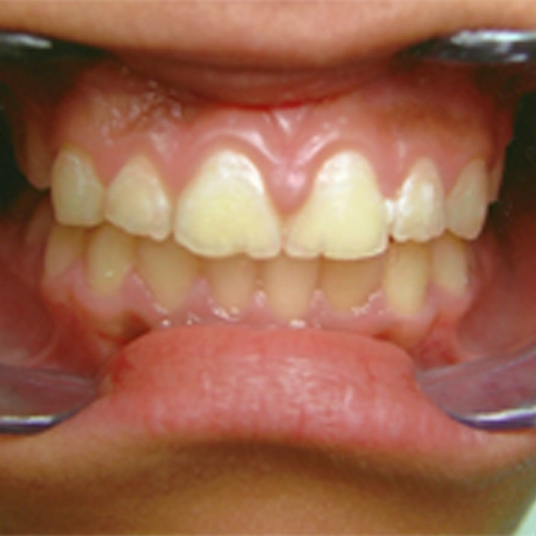 Braces after treatment at Millennium Dental, Bound Brook NJ