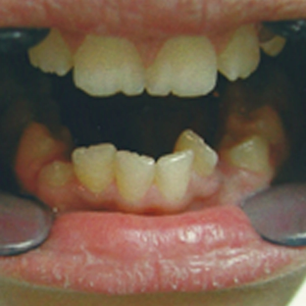 Braces before treatment at Millennium Dental, Bound Brook NJ